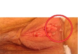 genital herpes symptoms in males #10